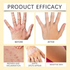 Vitigo Bee Venom Treatment Cream | Natural Skin Repair Hydration Relief Anti-Irritation
